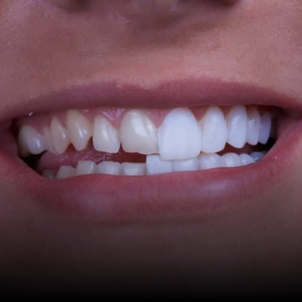 Cosmetics & Veneers