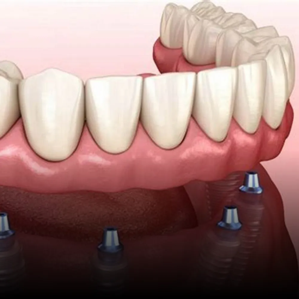 Full Mouth Reconstruction