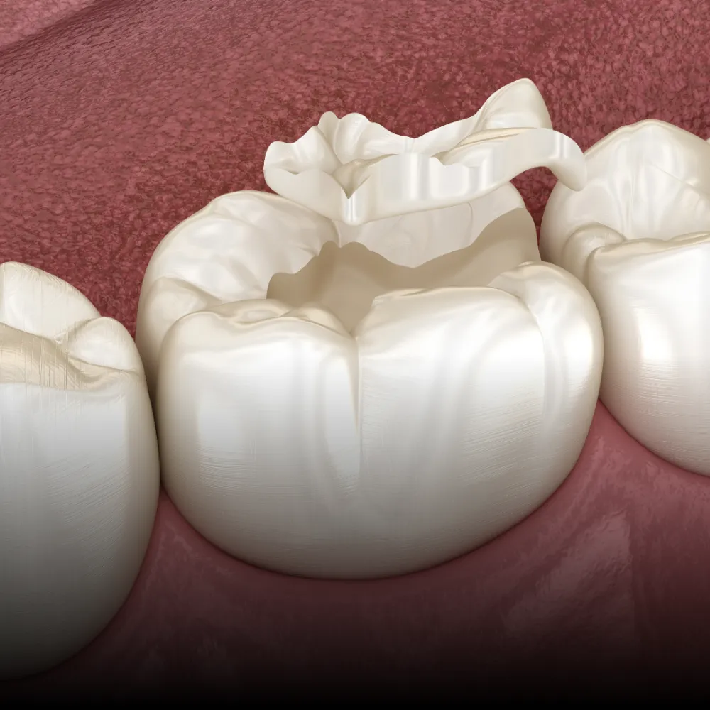 Fillings & Sealants
