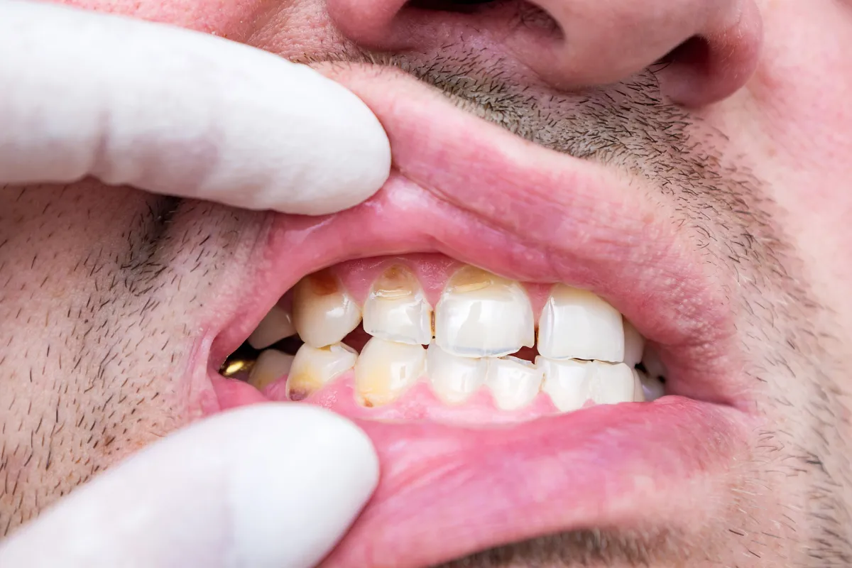 Chipped Tooth Repair: Restoring Your Smile Near Spring Creek Parkway, Plano, TX Close-up of a chipped tooth
