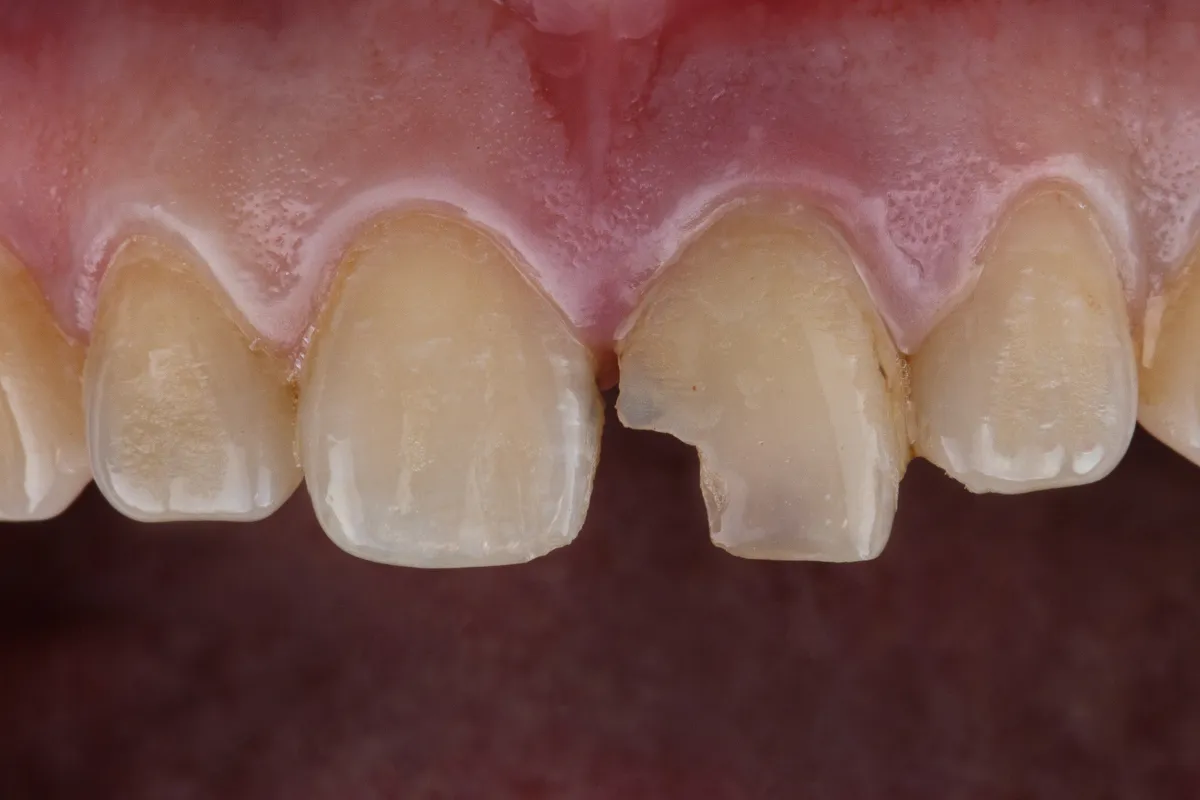 Chipped Tooth Repair: Restoring Your Smile Near Spring Creek Parkway, Plano, TX Dentist applying dental bonding to a chipped tooth