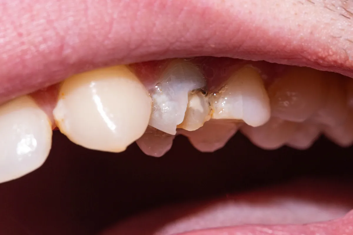 Chipped Tooth Repair: Restoring Your Smile Near Spring Creek Parkway, Plano, TX Person holding a piece of a chipped tooth