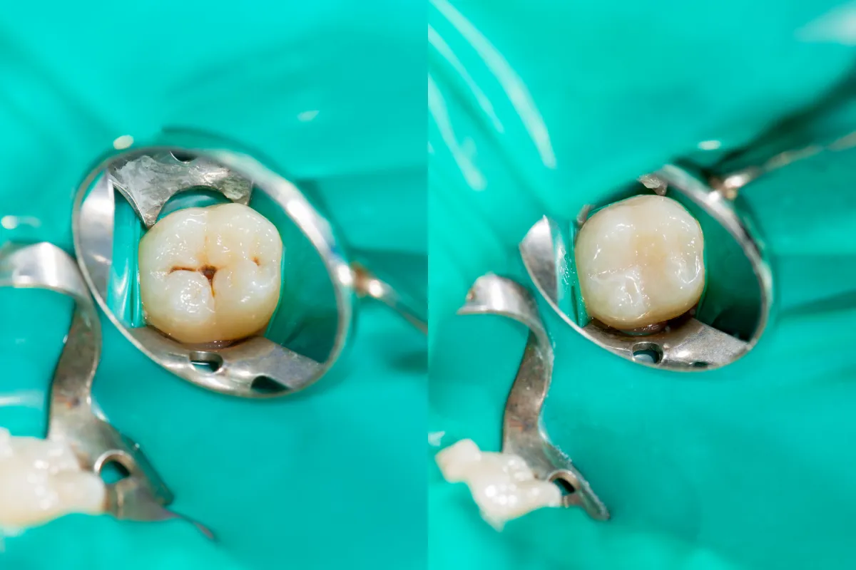 Tooth-Colored Fillings: A Discreet Solution for Plano Smiles, Plano, TX Dentist applying tooth-colored filling material