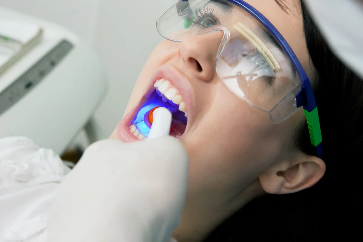 Tooth-Colored Fillings: A Discreet Solution for Plano Smiles, Plano, TX A dentist polishing a tooth-colored filling