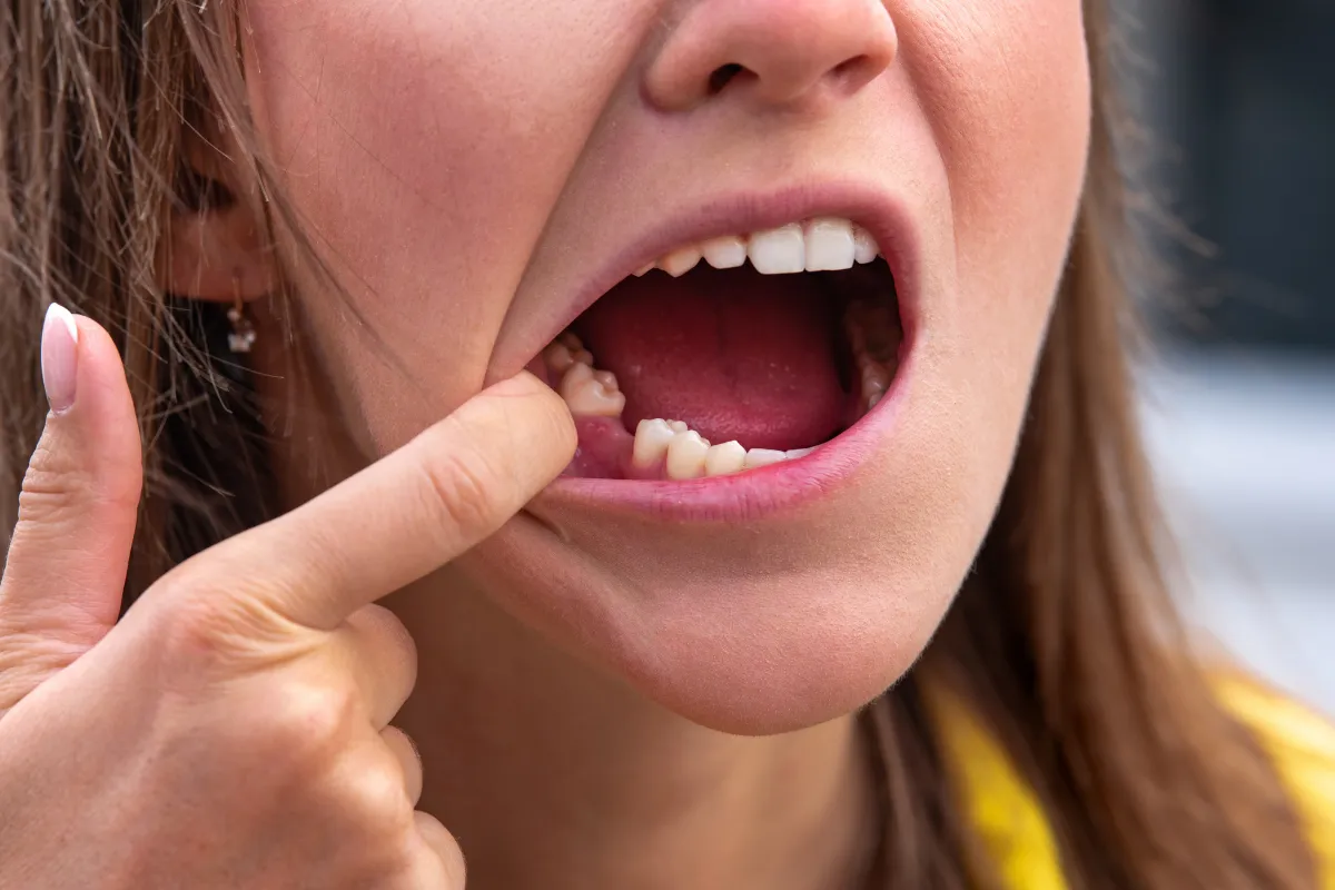 Bridge Missing Teeth in Plano: What Are Your Options on Spring Creek Parkway?, Plano, TX Dental bridge illustration