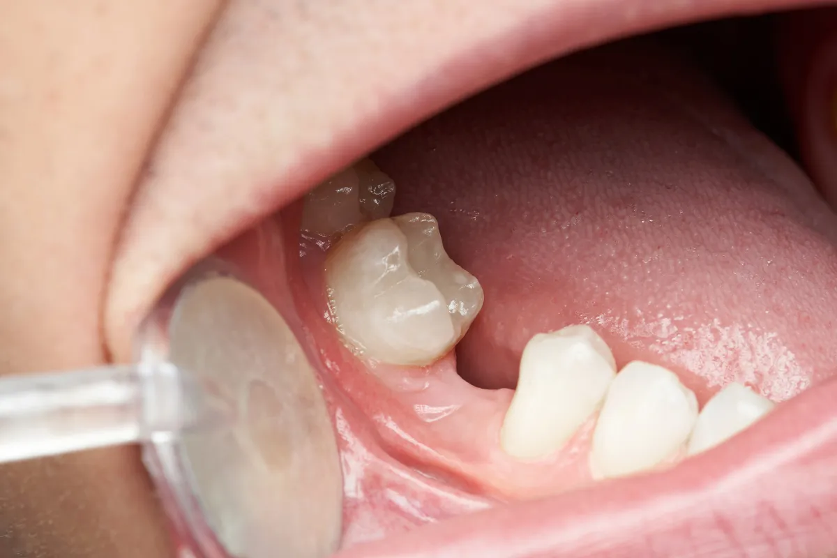 Bridge Missing Teeth in Plano: What Are Your Options on Spring Creek Parkway?, Plano, TX Process of dental bridge placement