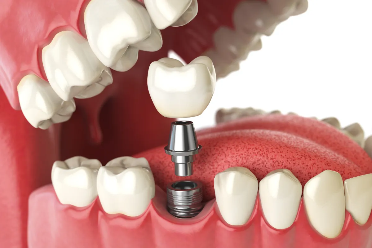 Single Tooth Implant Cost: Plano's Comprehensive Breakdown, Plano, TX Illustration of a single tooth implant process