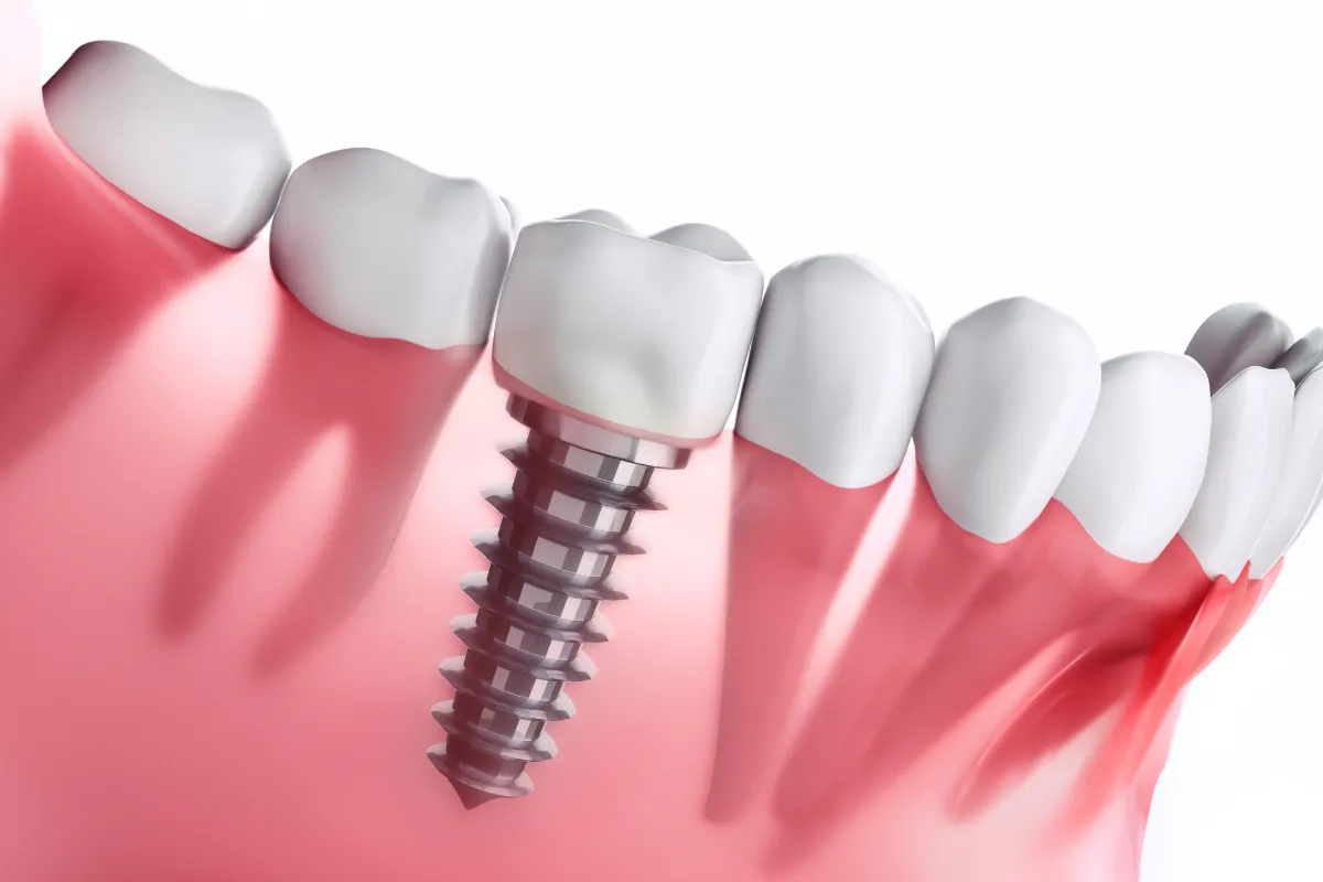 Single Tooth Implant Cost: Plano's Comprehensive Breakdown, Plano, TX Comparison of dental implant and bridge