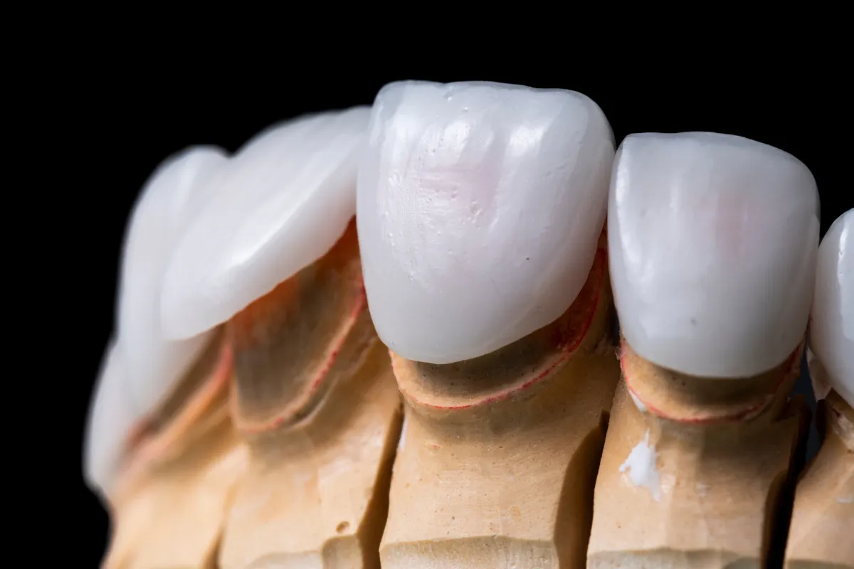 Veneers vs. Crowns: Which is Right for You in Plano?, Plano, TX Dental Veneers Before and After