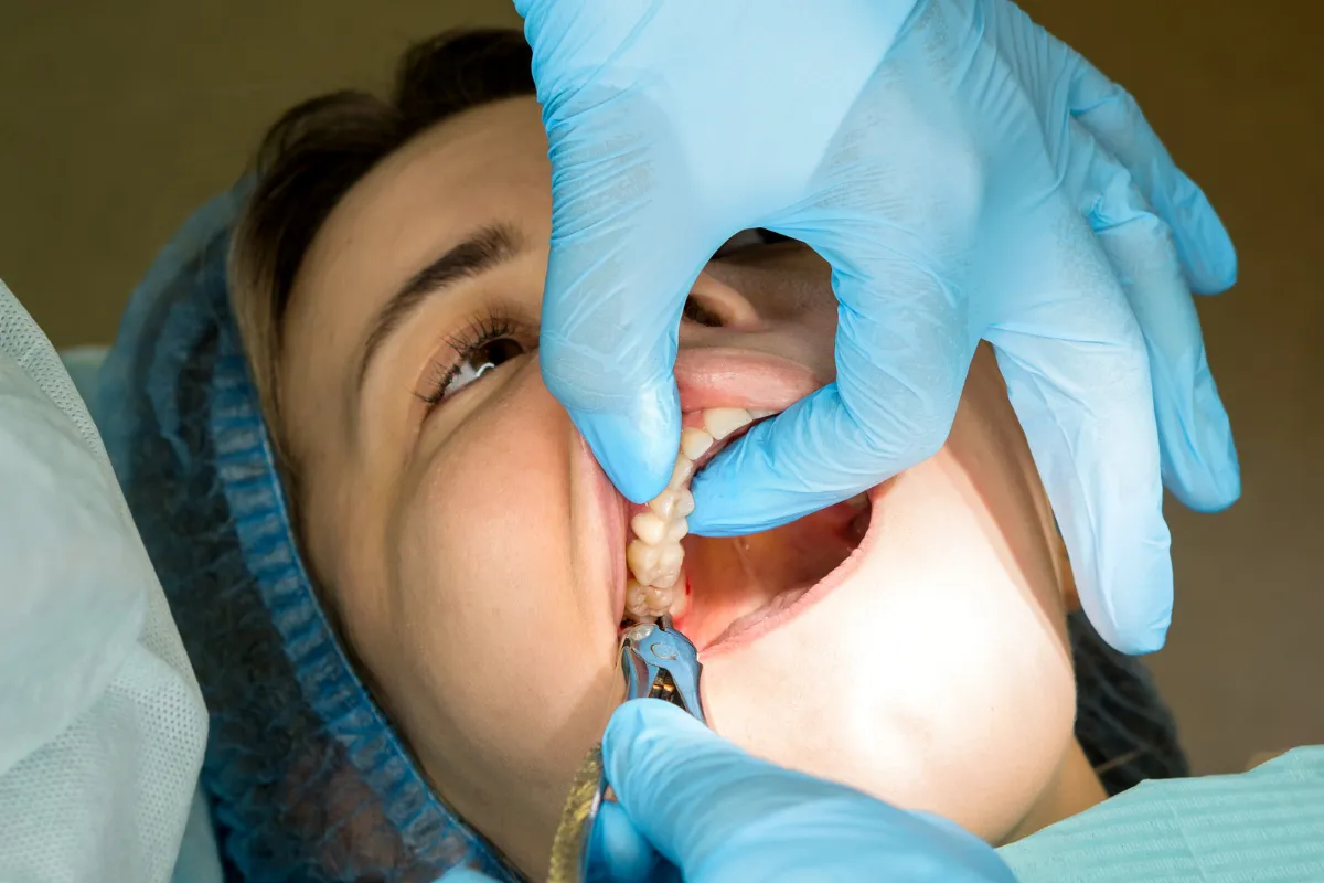 Post-Wisdom Teeth Extraction Care: Tips for Plano Residents, Plano, TX Illustration of dry socket