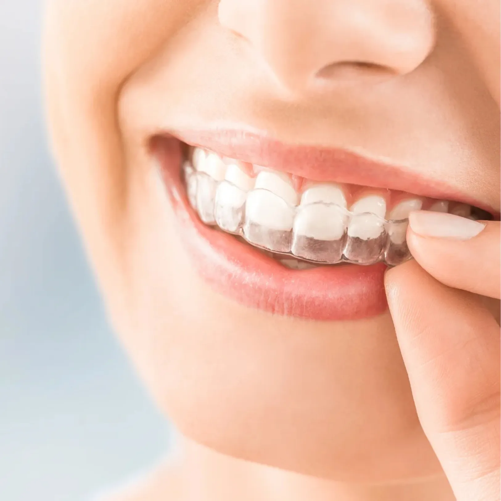 Aligners & Invisalign